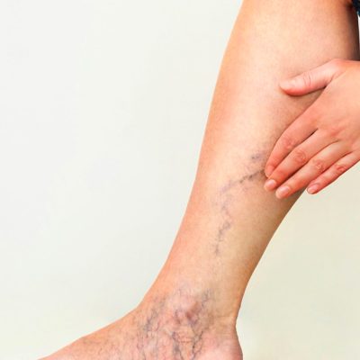 Escleroterapia