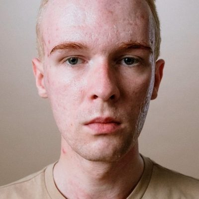 Huellas-de-acne
