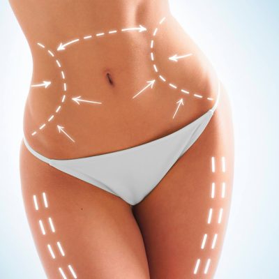 Lipoescultura-Laser